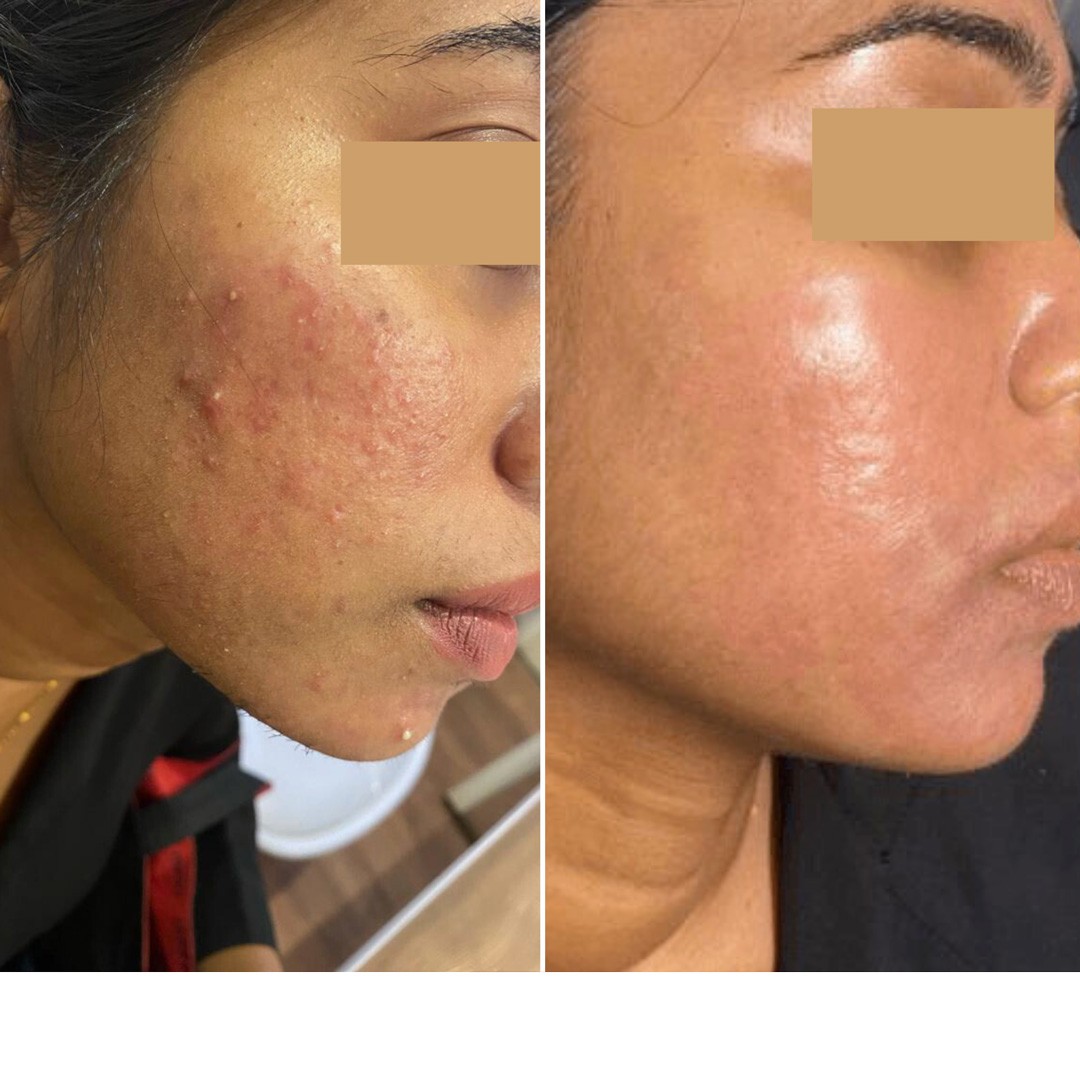 Before & After Photo Forma Treatment 