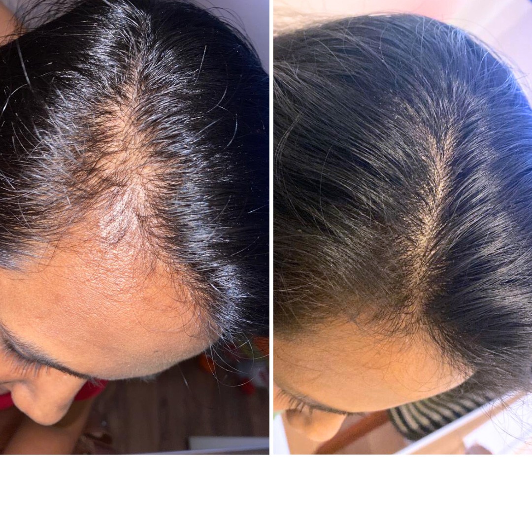 Before & After Photo Forma Treatment 