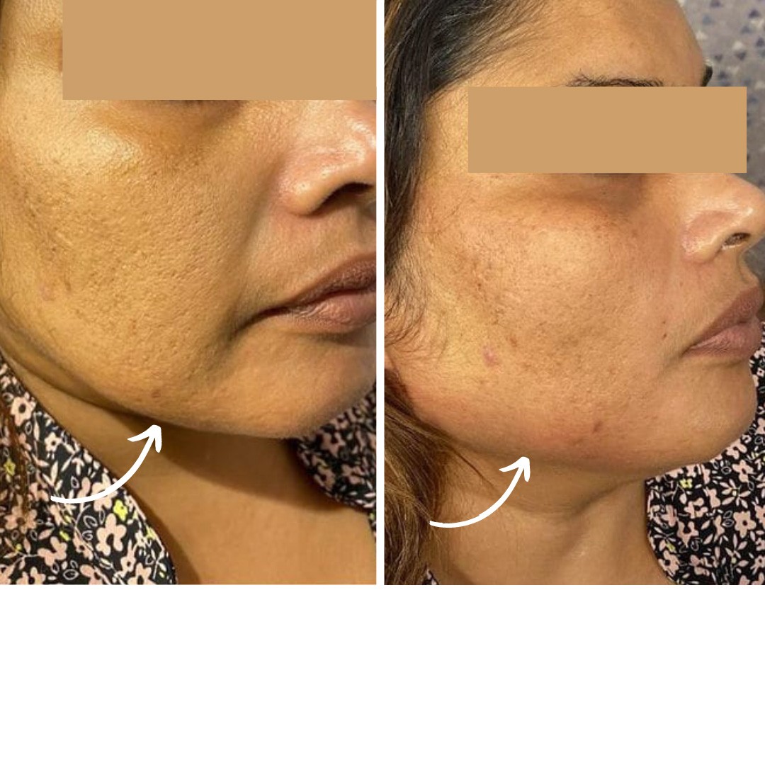 Before & After Photo Forma Treatment 