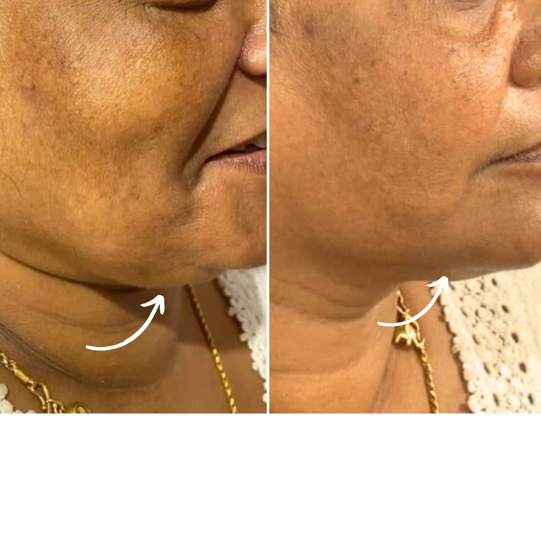 Before & After Photo Forma Treatment 