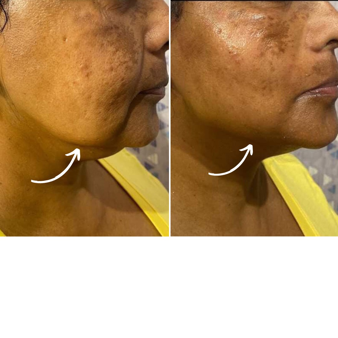 Before & After Photo Forma Treatment 