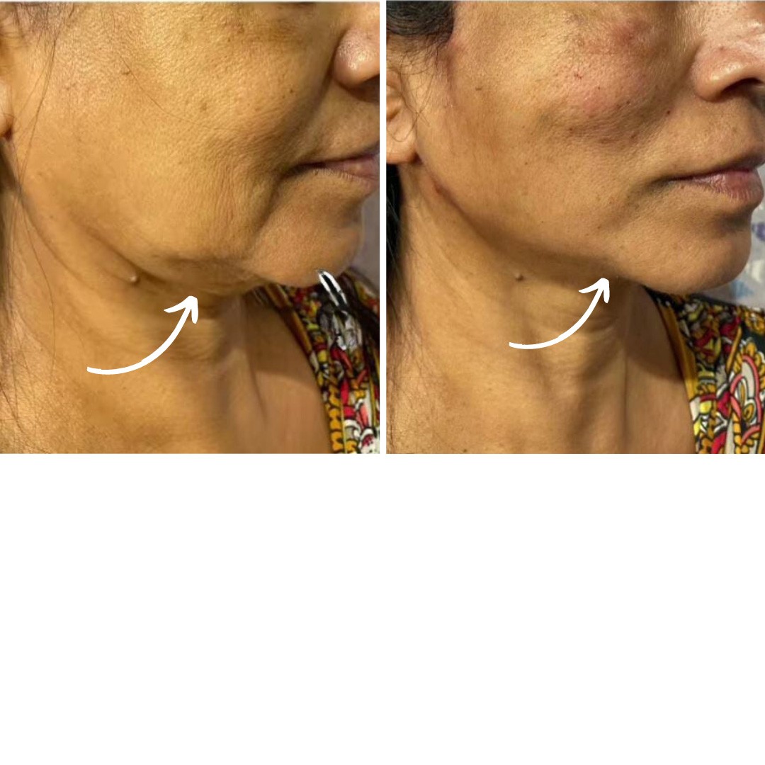 Before & After Photo Forma Treatment 