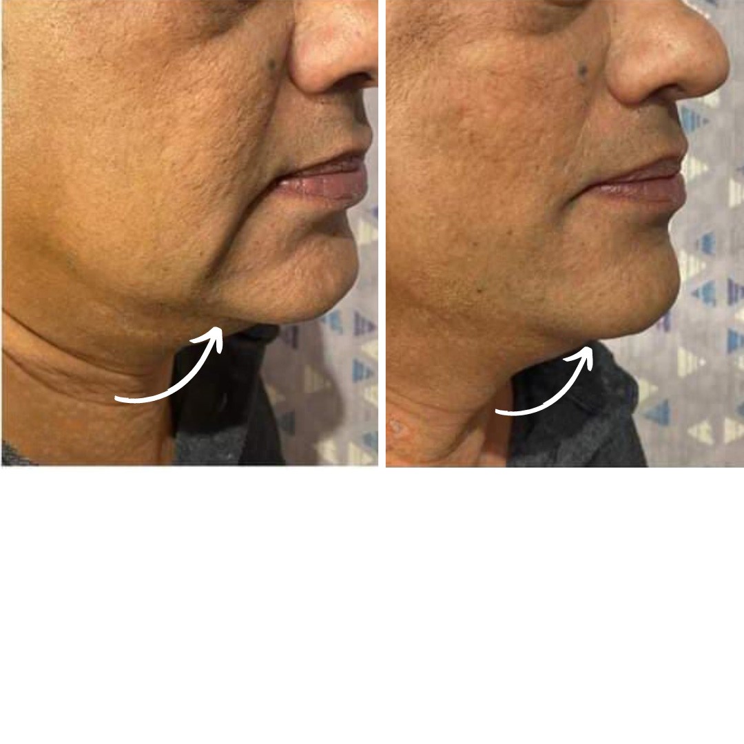 Before & After Photo Forma Treatment 