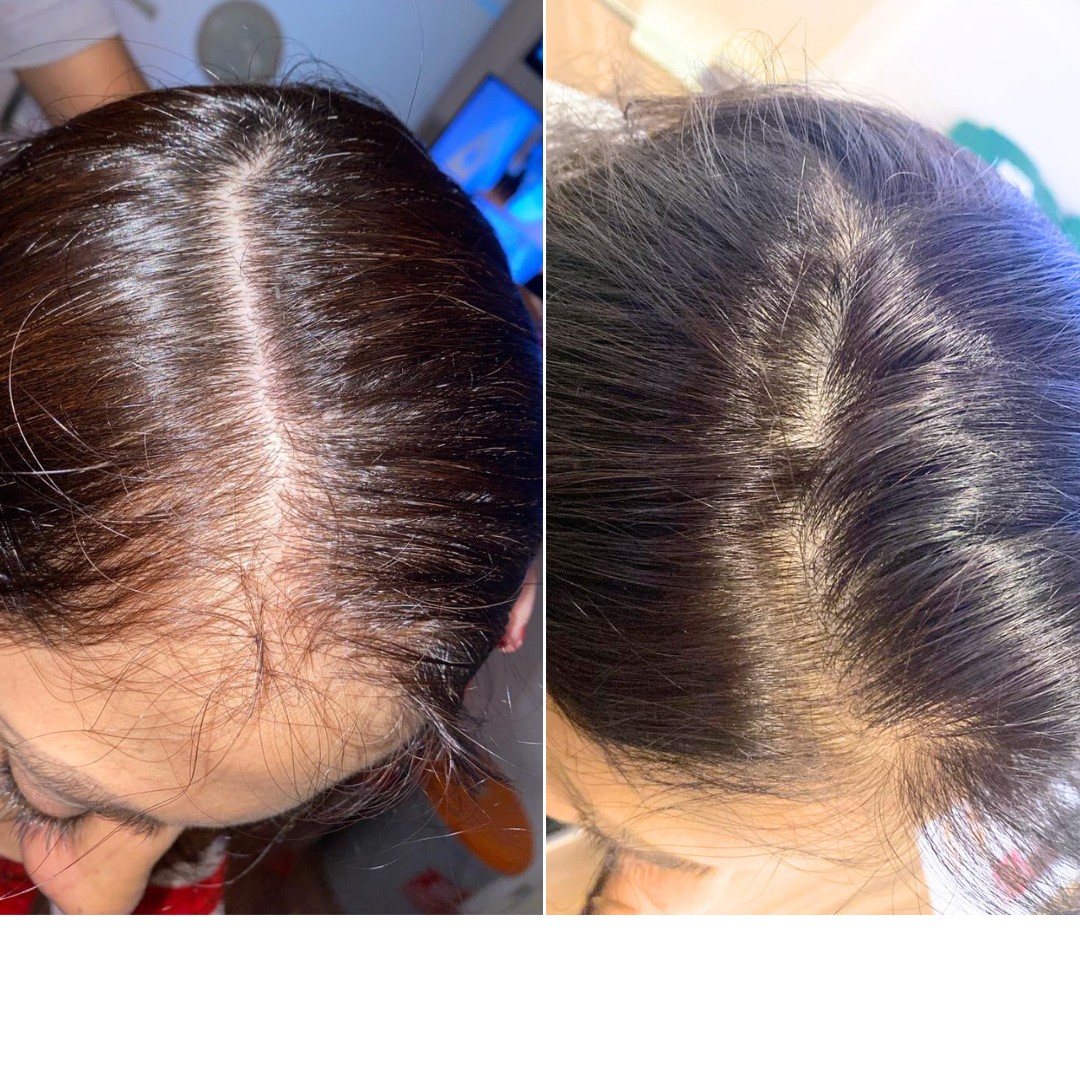 Before & After Photo Forma Treatment 