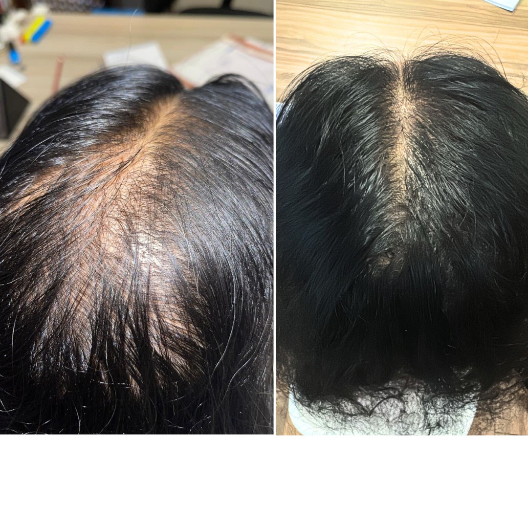 Before & After Photo Forma Treatment 