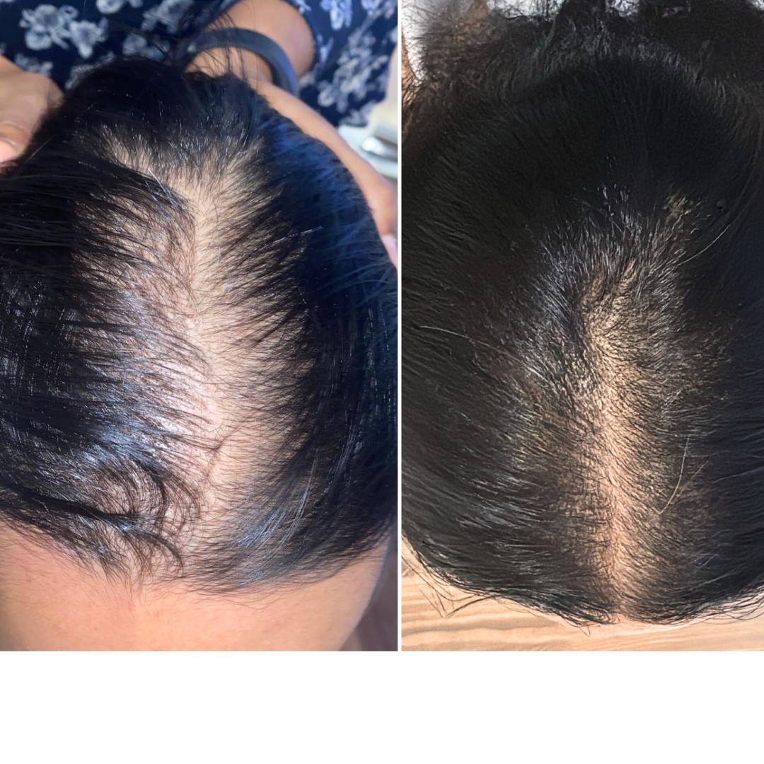 Before & After Photo Forma Treatment 