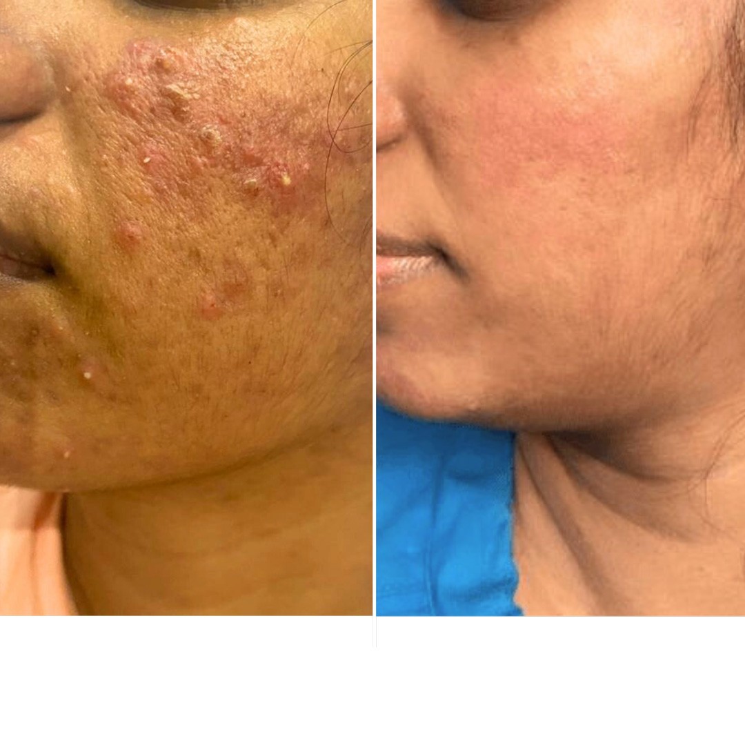 Before & After Photo Forma Treatment 