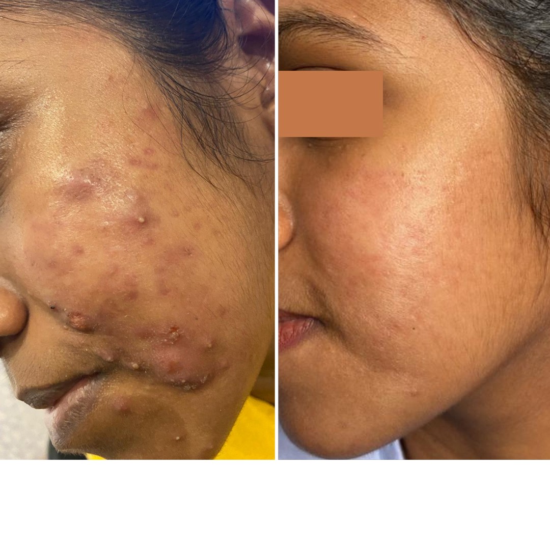 Before & After Photo Forma Treatment 