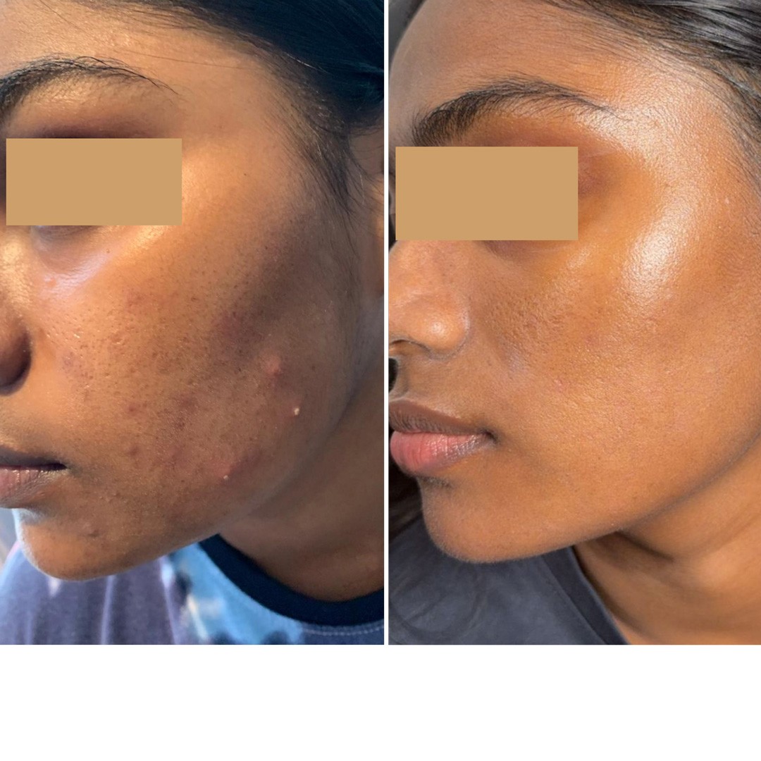 Before & After Photo Forma Treatment 