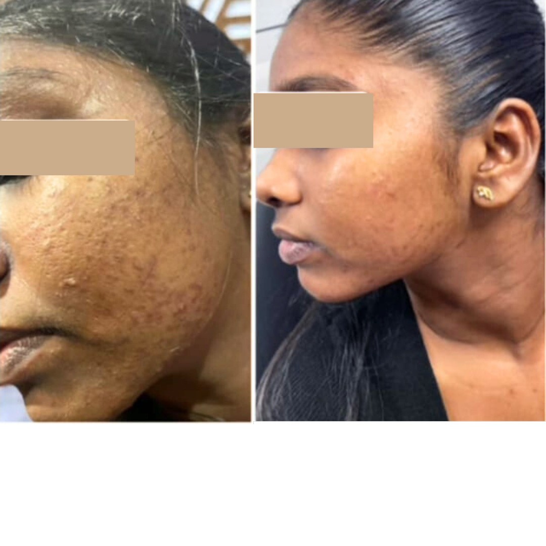 Before & After Photo Forma Treatment 