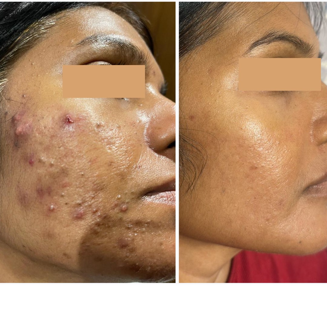 Before & After Photo Forma Treatment 