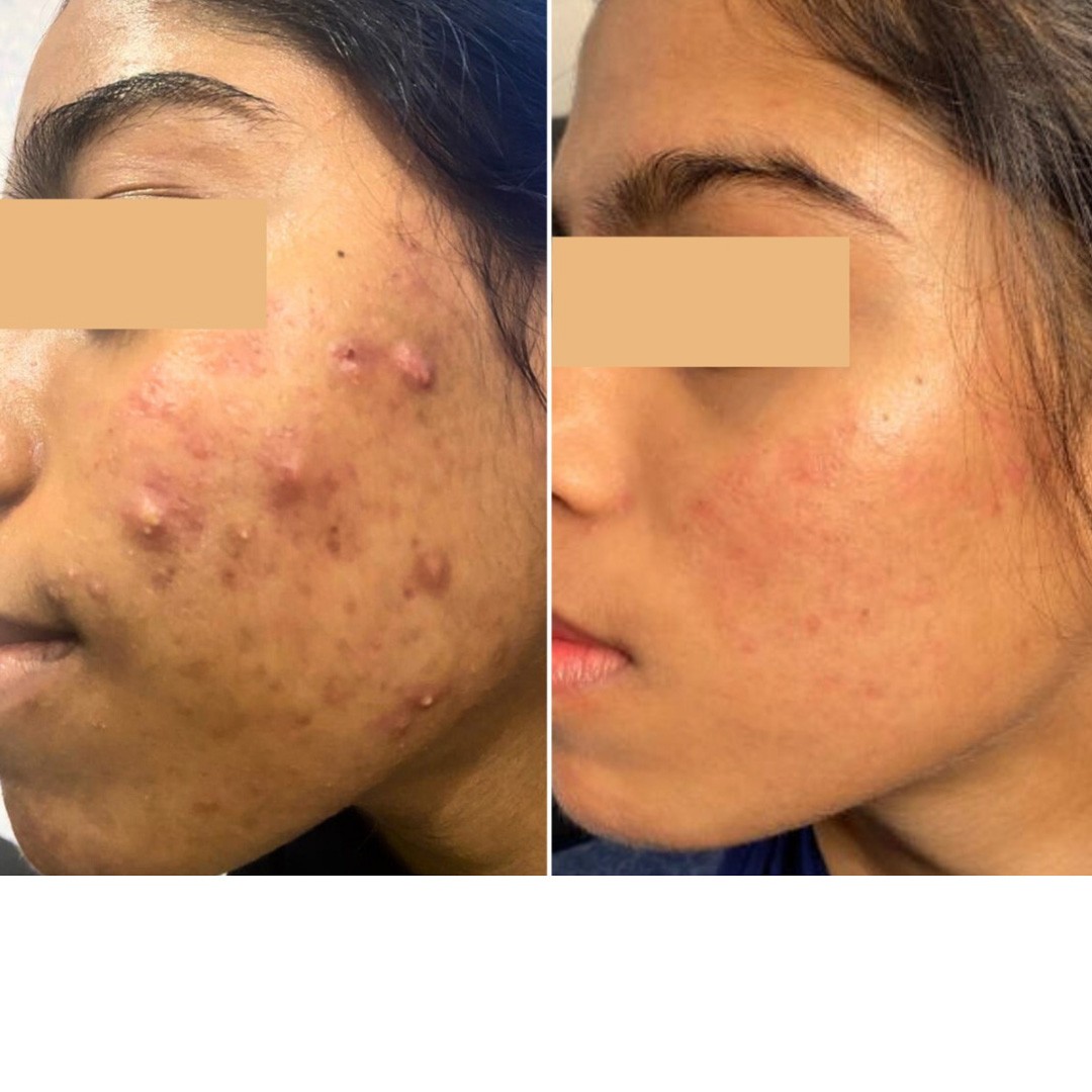 Before & After Photo Forma Treatment 