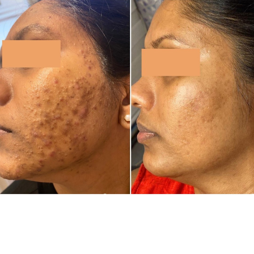 Before & After Photo Forma Treatment 